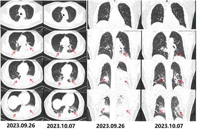 Efficacy of omadacycline in the treatment of Legionella pneumonia: a case report